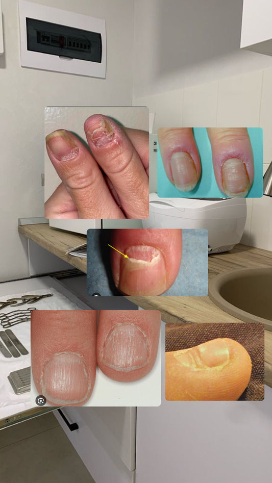 Maladies et pathologies de l'ongle
